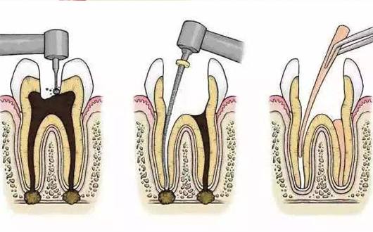 根管治療