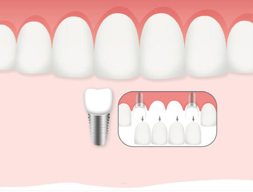 惟德口腔口腔種植怎么樣？惟德口腔就來為您一一解答