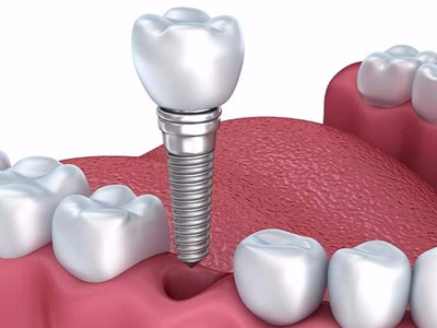 惟德口腔淺析口腔種植需要滿足哪些條件